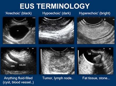 Ultrasound Sonography, Lymph Nodes, Tumor, Blood Vessels, Liver, Medical, Study, Basic, Healthy