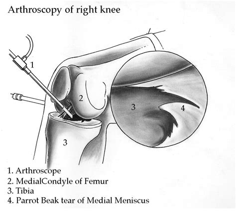 Arthroscopy of right knee by marcgosselin on DeviantArt