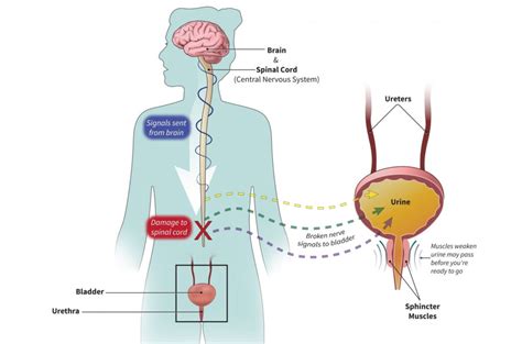 Neurogenic Bladder: Common Causes | Department of Surgery | Washington ...