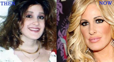 Chatter Busy: Kim Zolciak Plastic Surgery