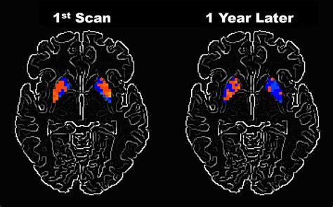 Researchers examine how Parkinson’s disease alters brain activity over ...