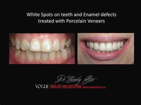 White Spots on Teeth and Enamel Defect Treatment Melbourne