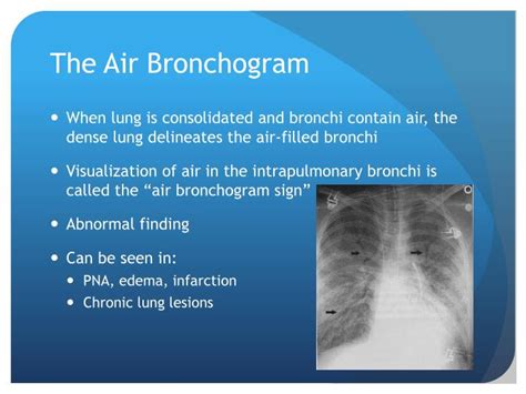 PPT - Chest X-Ray Interpretation for the Internist PowerPoint Presentation - ID:934924