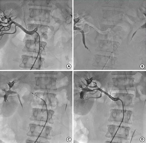 An Open-label, Single-arm, Multicenter Feasibility Study Evaluating the Safety of Catheter-based ...