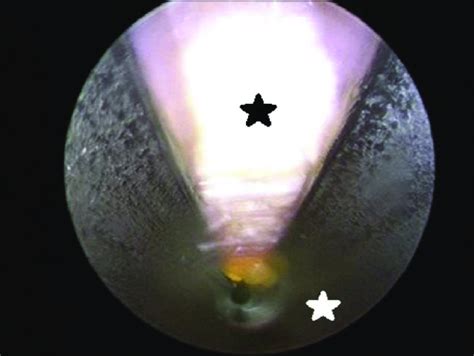 Endoscopic image of transverse carpal ligament (black star), viewed ...