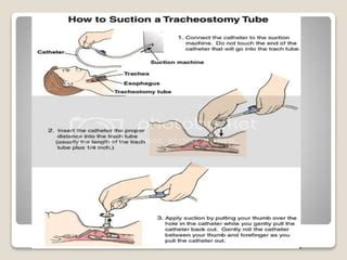 suctioning procedure ppt.pptx