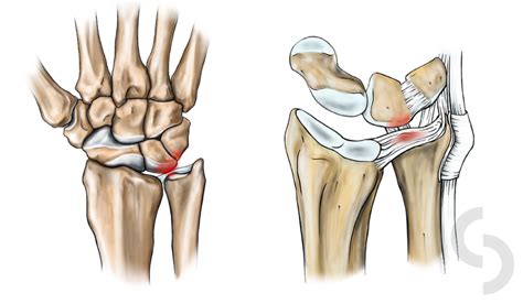 Ulno-Carpal Abutment Impaction | dr Sonja Cerovac