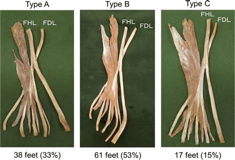 Classification of the connections of the FHL tendon slip to the lesser ...