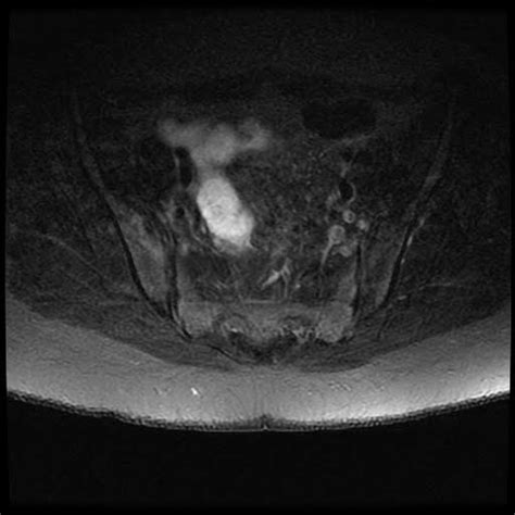 Radiology Cases: Unilateral sacroiliitis