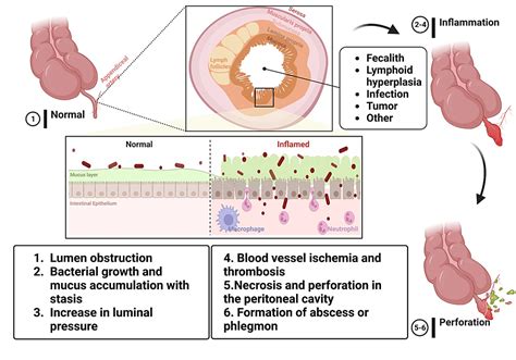 Cureus Typical And Atypical Presentations Of Appendicitis, 56% OFF