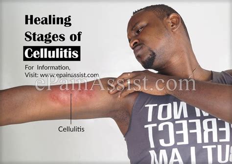 Healing Stages Of Cellulitis | Cellulitis remedies, Cellulitis infection, Healing