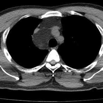 (PDF) Mediastinal hibernoma: An uncommon tumor