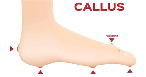 Why is foot callus a problem in Diabetes?