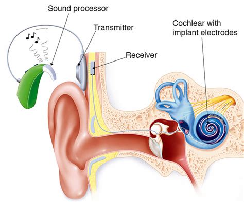 Cochlear implant function, surgery and cochlear implant pros and cons