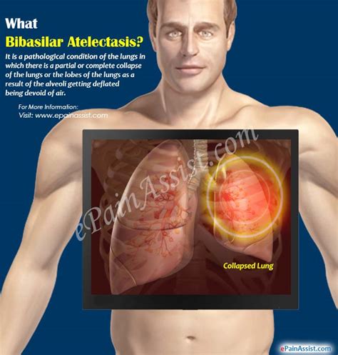 Bibasilar Atelectasis|Causes|Symptoms|Treatment|Diagnosis