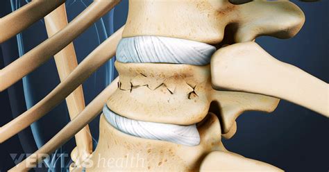 Compression Fractures Spine Treatment