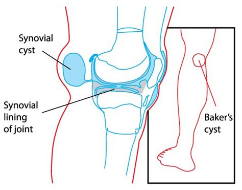 Baker's Cyst of The Knee - Queensland Lower Limb Clinic