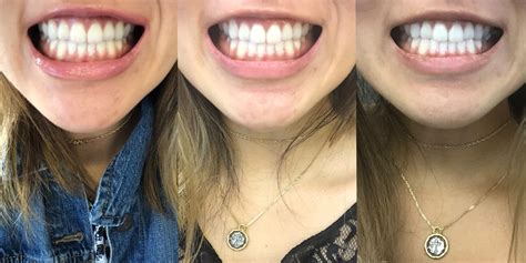 By Colgate Review: New Teeth Whitening Kit Is Worth It, 41% OFF