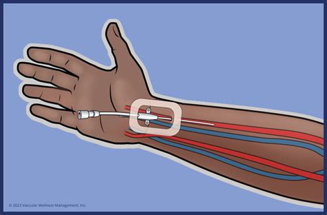 Arterial Lines | Vascular Wellness