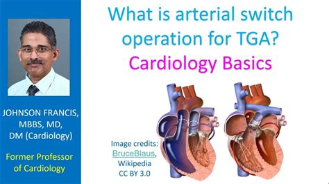 What is arterial switch operation for TGA? Cardiology Basics - YouTube