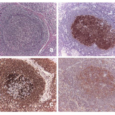 (PDF) Comparison of germinal center markers CD10, BCL6 and human ...