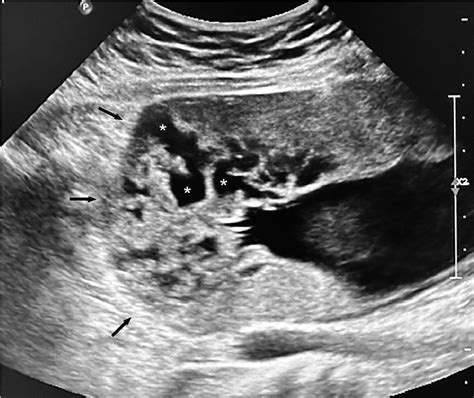 Extensive fundal placenta accreta spectrum (PAS) in a nulliparous patient with an unscarred ...