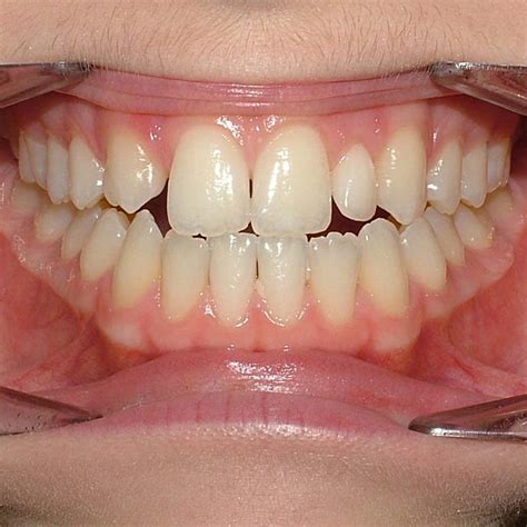 Before and After Photos – Orthodontist Ottawa ON | Centrepointe ...