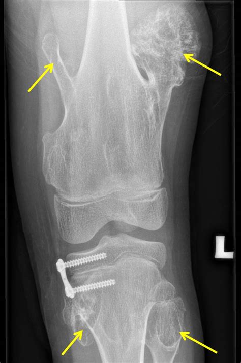 Hereditary multiple exostosis – Radiology Cases