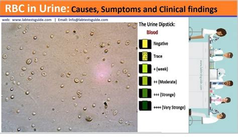 RBC In Urine: Causes And Clinical Significations | Lab Tests Guide