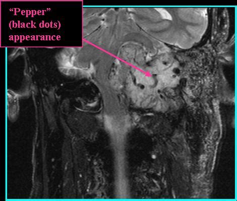 Jugular / Jugulotympanic Paraganglioma - Radiology | Iowa Head and Neck Protocols