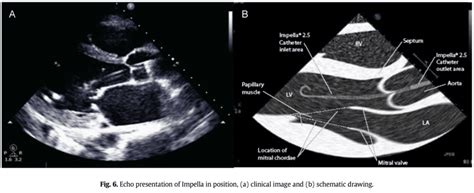 Impella Devices 101 - REBEL EM - Emergency Medicine Blog