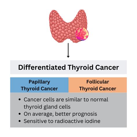 What Does it Mean to have “Differentiated Thyroid Cancer”? – Qualisure