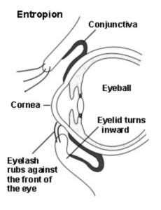 Entropion Surgery - Sunshine Eye Surgeons