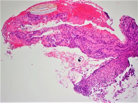 Pathology Outlines - Stercoral ulcer