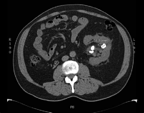 CT Scans Overused in Emergency Departments for Kidney Stone Imaging ...