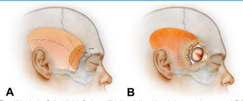 Figure 1 from MINI-PTERIONAL CRANIOTOMY FOR CLIPPING OF ANTERIOR CIRCULATION ANEURYSMS ...