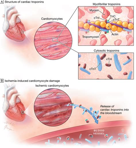 Increasingly Sensitive Assays for Cardiac TroponinsA Review | Acute Coronary Syndromes | JAMA ...