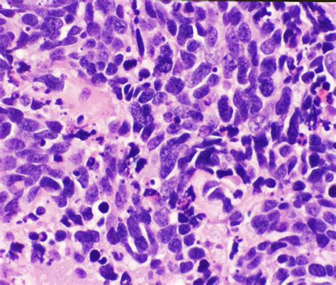 Small Cell Carcinoma