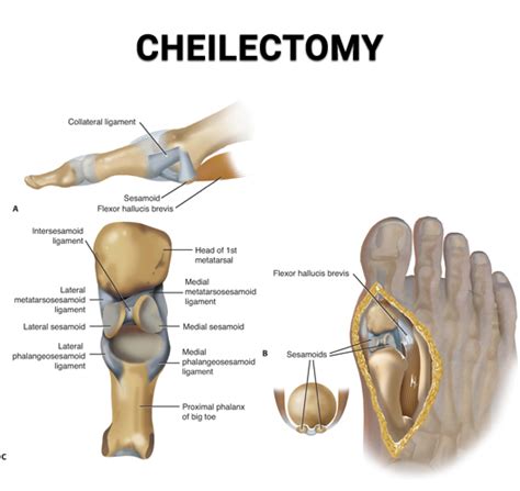 Cheilectomy - Premier Podiatry in Clifton, NJ