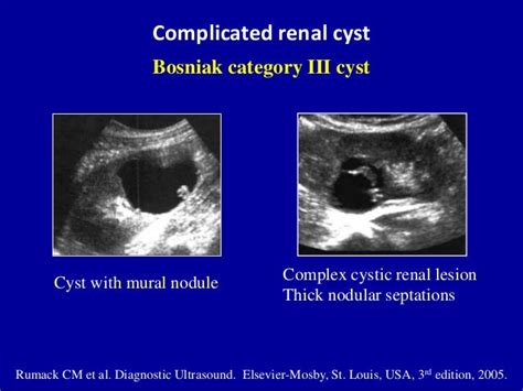 Ultrasound of the urinary tract - Renal cysts