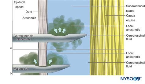 regional-anesthesia-correct-needle-placement - NYSORA
