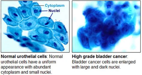 Cancer Cells Under Microscope