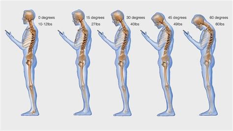 Text Neck Syndrome - Signs Symptoms and Solutions