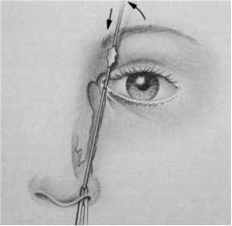 Operative Technique - Nasolacrimal Ducts - RR School Of Nursing