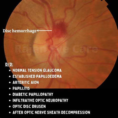 Disc Hemorrhages - Differential Diagnosis!