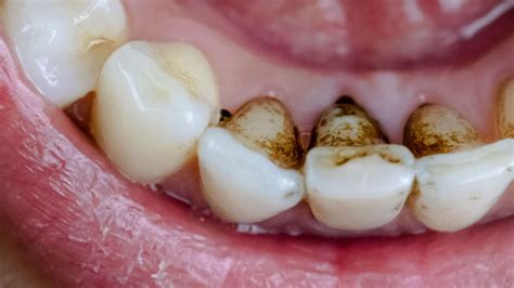 Black Stains On Teeth: Causes and Treatment in Bassendean