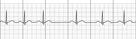 Ekg Normal Sinus Rythms Sinus Bradycardia And More Leveluprn | Free Download Nude Photo Gallery