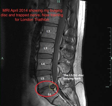 Can a physio have a slipped disc? - Boost Physio