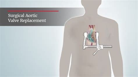 Surgical aortic valve replacement through open heart surgery