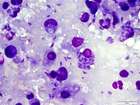 Pathology Outlines - Toxoplasma gondii